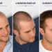 Hair transplant progress timeline showing pre-op, 6-month, and 12-month results with gradual hair regrowth, increased density, and a restored natural hairline.