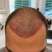 Close-up of a scalp one week after a hair transplant, showing newly implanted hair grafts, mild redness, and healthy early healing across the frontal hairline.