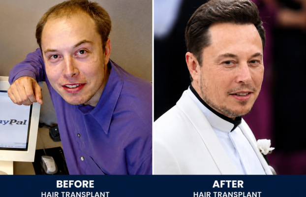 Celebrity Hair Transplants: Famous Hair Transformations Explained