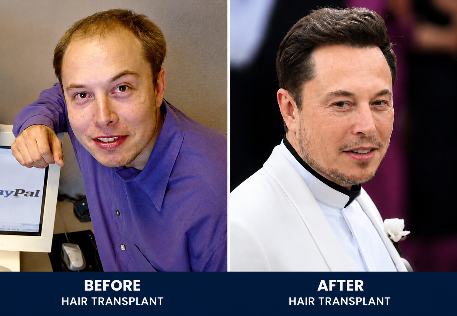 Celebrity Hair Transplants: Famous Hair Transformations Explained