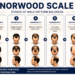 Norwood Scale infographic illustrating the seven stages of male pattern baldness, from minimal hairline recession to advanced hair loss, with front, top, and side views of each stage.
