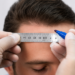 Hair restoration surgeon carefully designing a natural hairline with a surgical marker during a pre-operative consultation for a personalized hair transplant.