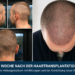 Ergebnisse eine Woche nach einer Haartransplantation mit Darstellung des Spenderbereichs aus verschiedenen Perspektiven sowie des Empfängerbereichs am Haaransatz mit gesunden Grafts, leichter Rötung und einem normalen frühen Heilungsverlauf.