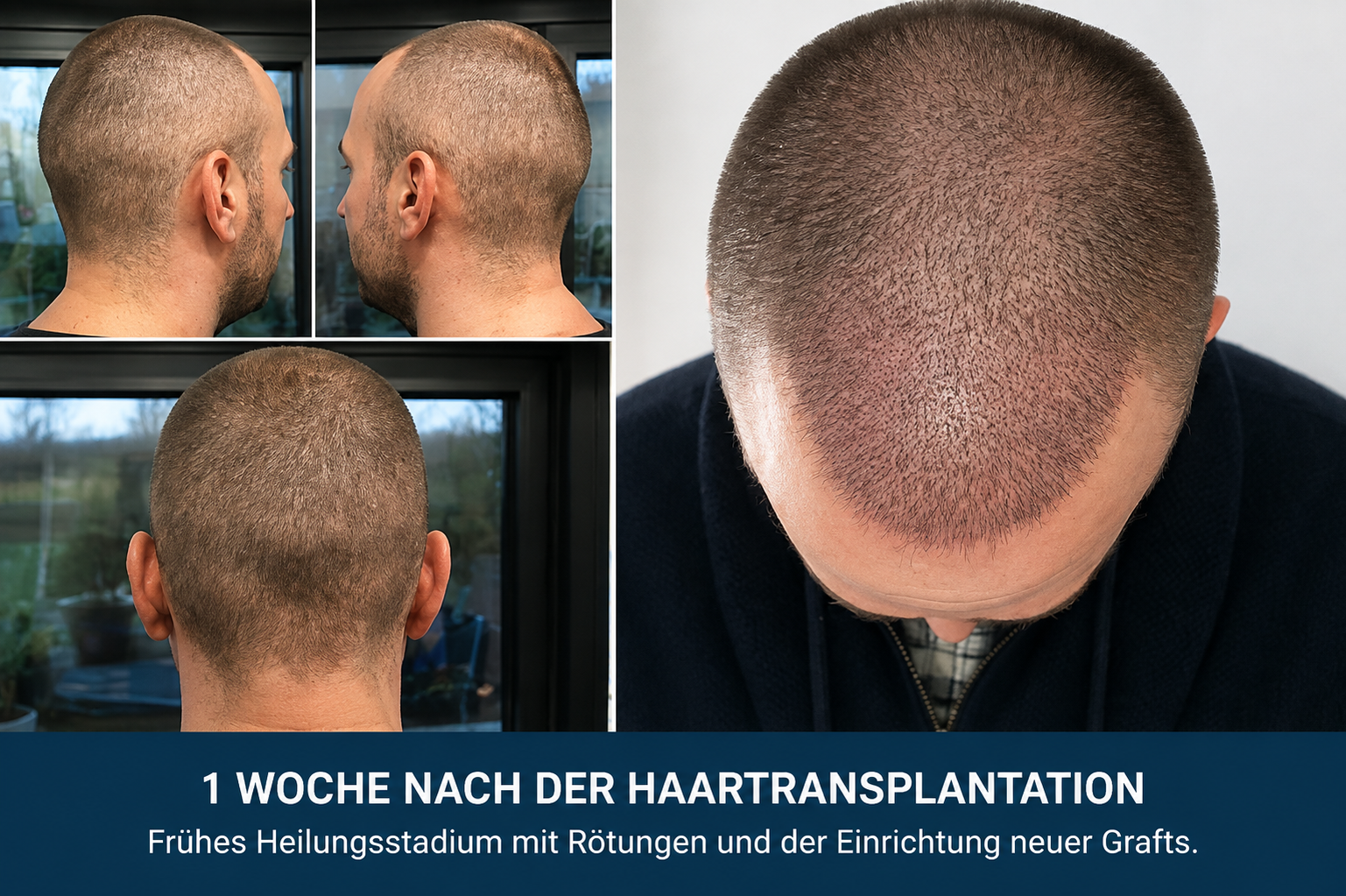 Haartransplantation nach 7 Tagen: Heilungsverlauf und was Sie erwarten können