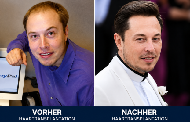 Haartransplantationen bei Prominenten: Berühmte Haartransformationen erklärt